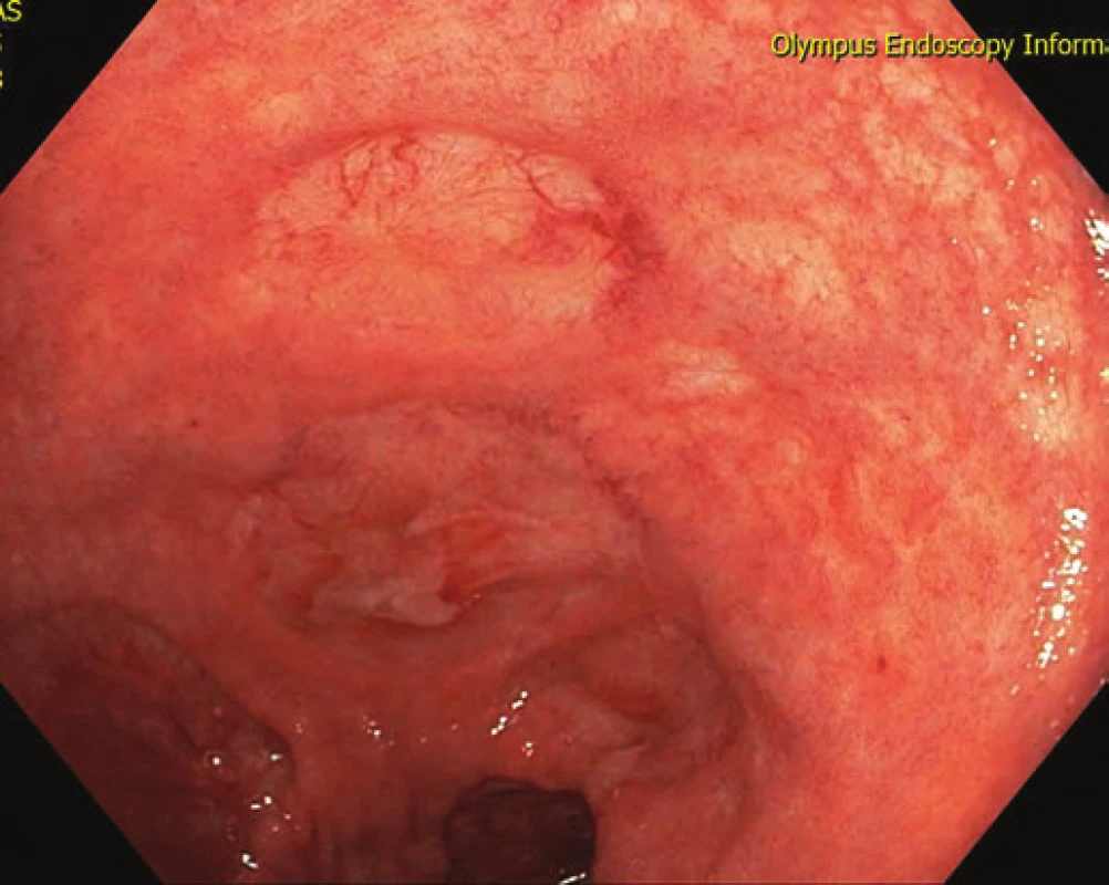 Kompletní reepitelizace ulcerací rekta.
Fig. 6. Complete reepithelisation of rectal ulcers.