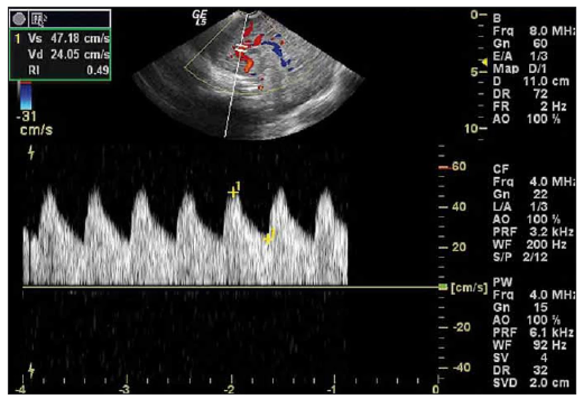 Obr. 1. Duplexní dopplerovské UZ vyšetření mozku donošeného novorozence (chlapec, gestační stáří 41 + 0), sagitální rovina.
Fig. 1. Duplex Doppler US of a term-neonatal brain (boy, gestational age 41 + 0), sagittal plane.