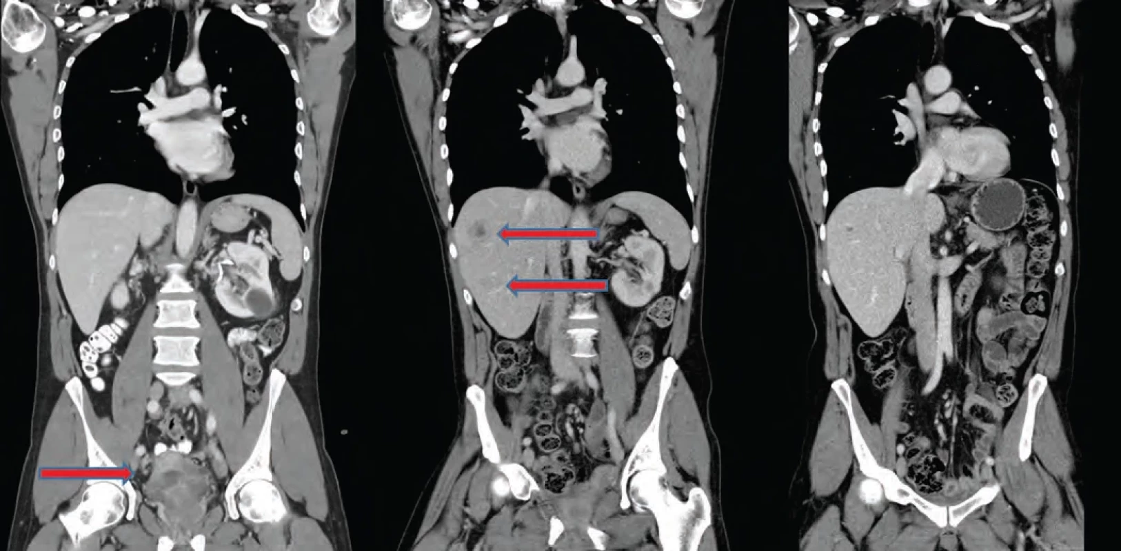 A. primární tumor – lokálně pokročilý, bez diseminace; B. jaterní metastázy – selhání platinového režimu, rozhodnutí o zahájení pembrolizumabu; C. poslední restagingové CT – kompletní regrese metastáz po pembrolizumabu.