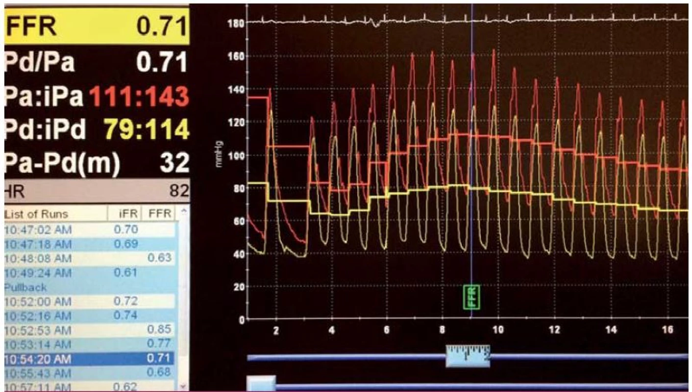 FFR angiograficky hraniční stenózy RIA, tlakový gradient na stenóze při hyperemii adenozinem s hodnotou FFR 0,71 svědčí pro hemodynamicky významné postižení.
Červená křivka odpovídá tlaku v aortě, zelená křivka tlaku z intrakoronárního vodiče za stenózou.