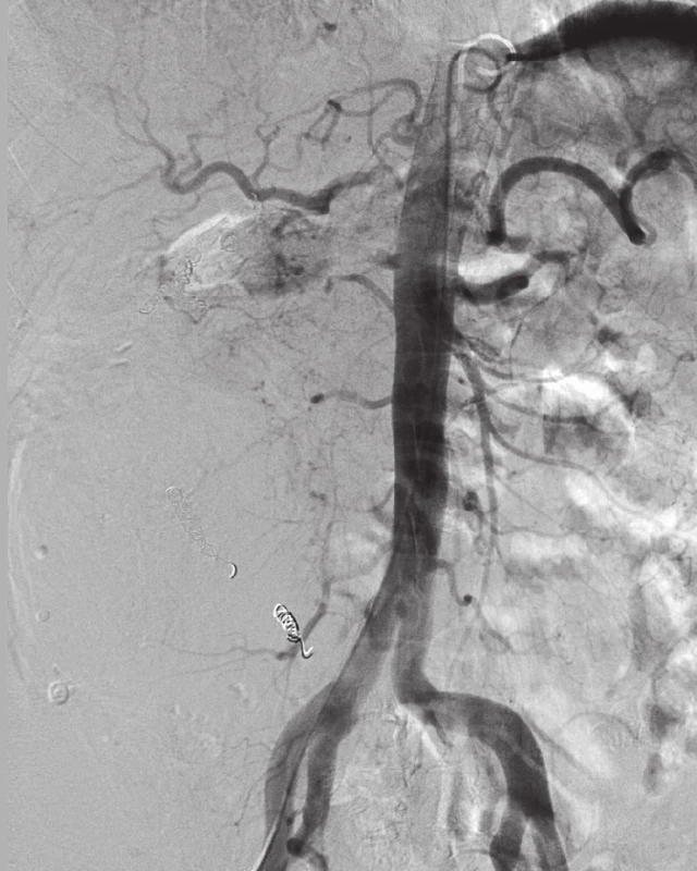 Embolizace inoperabilního tumoru pravé ledviny Tumor je zásoben kromě renální tepny další kaudální arterií. Pomocí přípravku Embosphere<sup>®</sup>, spirál Tornado<sup>®</sup> a přípravku Histoacryl<sup>®</sup> uzavřena postupně dolní pólová arterie a poté i hlavní renální tepna. 
Fig. 2. Embolization of an inoperable tumor of the right kidney In addition to a renal artery the tumor is also supplied by another caudal artery. With the use of Embosphere <sup>®</sup>, Tornado<sup>®</sup> microcoils and Histoacryl<sup>®</sup> the lower pole artery and then also the general artery gradually closed.