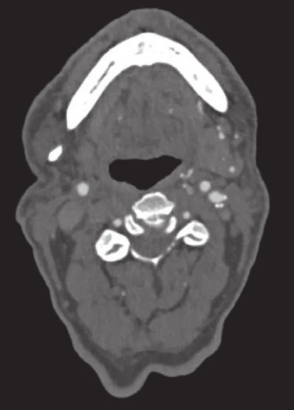 Kontrolní CTA po 3 letech od operace. ACI průchodná, okolí bez metastáz
Fig. 9: Control CTA 3 years after surgery. CIA with blood flow, no metastases around