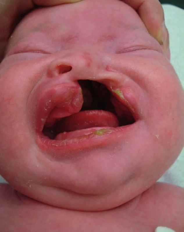 Pacient s celkovým jednostranným rozštěpem před operací v 1. týdnu života.
Fig. 1. Patient with a total unilateral cleft palate before the surgery in the first week of life.