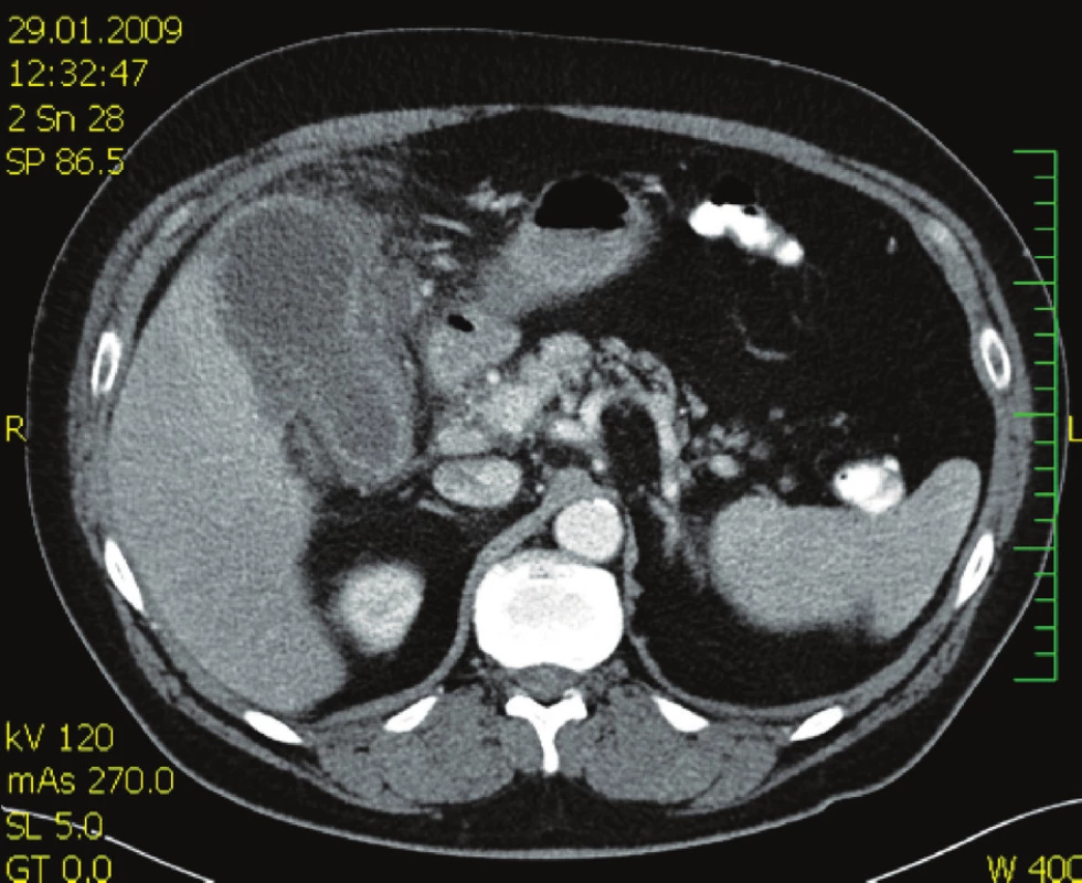 CT vyšetření břicha s nálezem rozšíření stěny žlučníku a tekutinou v lůžku žlučníku
Fig. 1. Abdominal CT examination showing a thickened gall bladder wall and fluid within the gall bladder bed