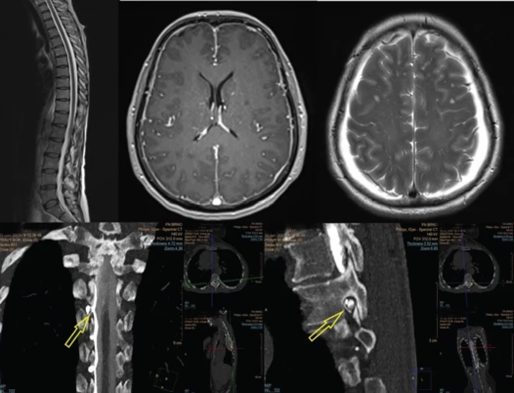 Vyšetření MR a dynamická CT myelografi e detekující likvoro-venózní fi stulu.</br>Fig. 1. MRI and dynamic CT myelography detecting CSF-venous fi stula.
