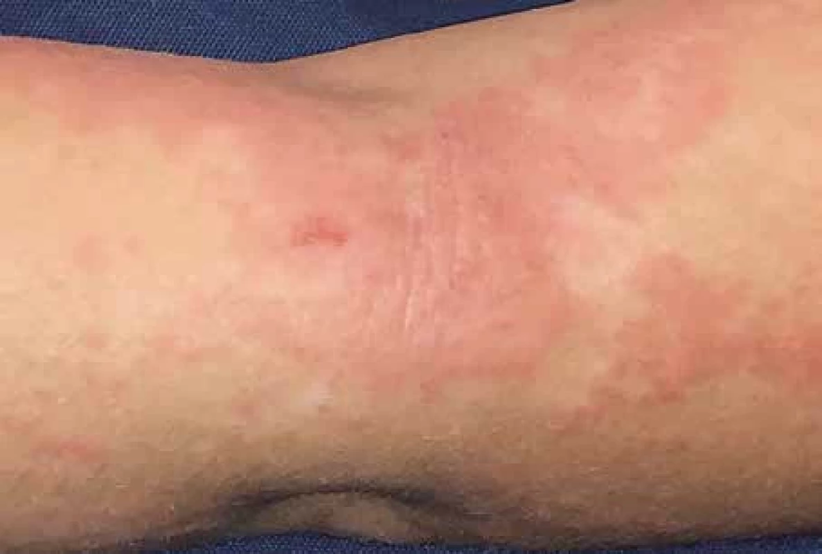 Kopřivka v terénu lichenifikace u atopické dermatitidy.