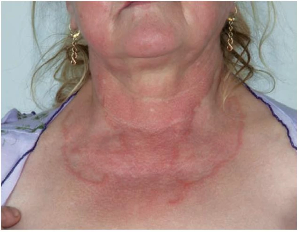 Granuloma anulare – rozsáhlé anulární projevy