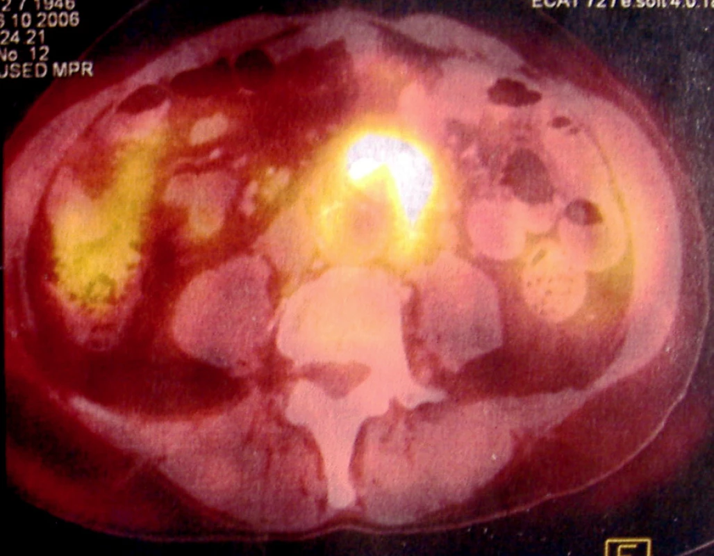 Předoperační FGD-PET scan zobrazuje hypermetabolickou tkáň v okolí aortobifemorální protézy
Fig. 2. Preoperative FDG-PET scan shows hypermetabolic tissue in the neighbourhood of the aortobifemoral prosthesis