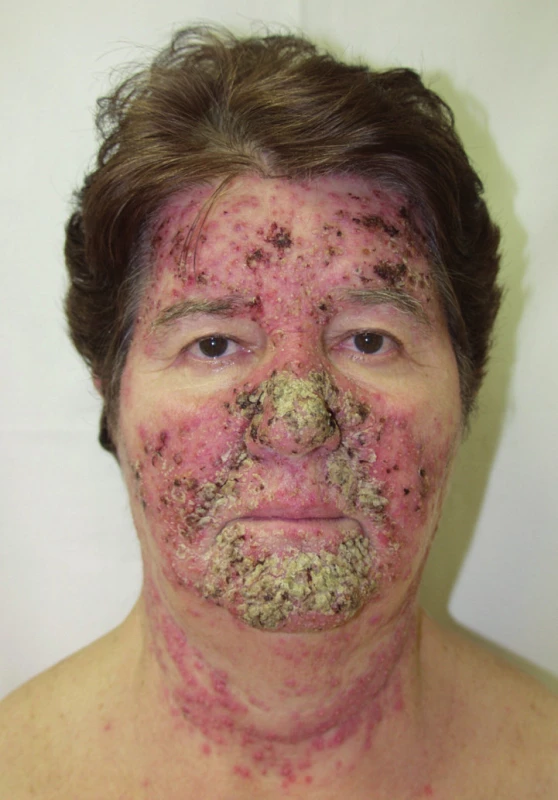 Exantém připomínající impetigo na obličeji po erlotinibu.