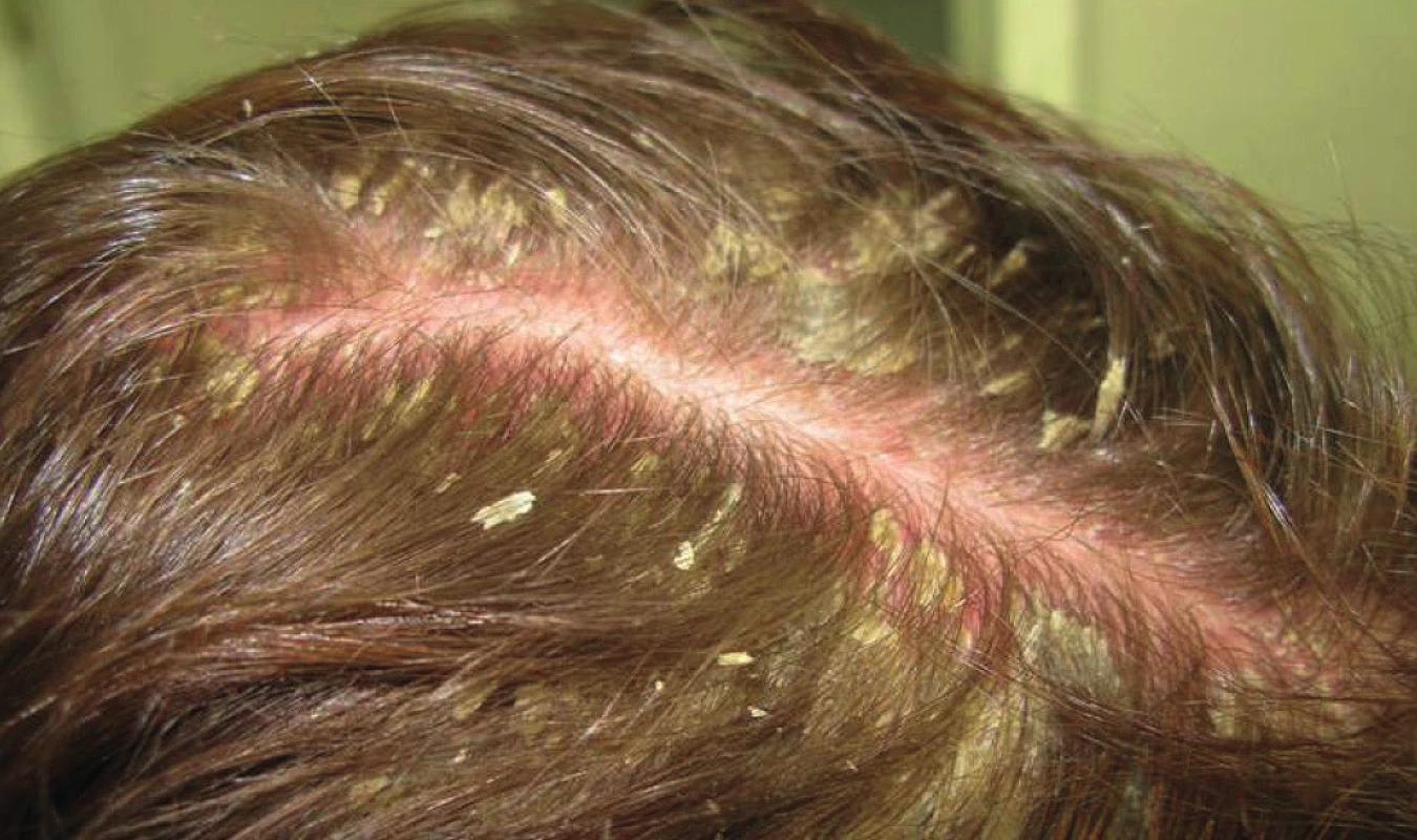 Seboroická dermatitida ve kštici; mezoterapie je nevhodná