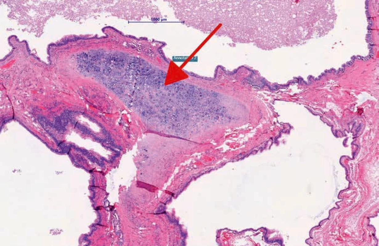 Detail – prostory jsou vystlány víceřadým cylindrickým (respiračním) epitelem (značeno šipkou).
