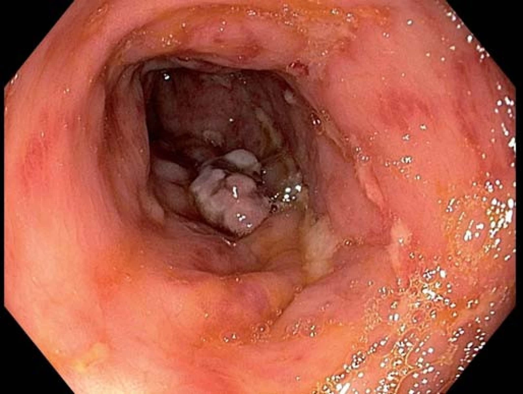 Endoskopické známky aktivity Crohnovy choroby v sigmatu.
Fig. 1. Endoscopic activity of Crohn’s disease in the sigmoid colon.