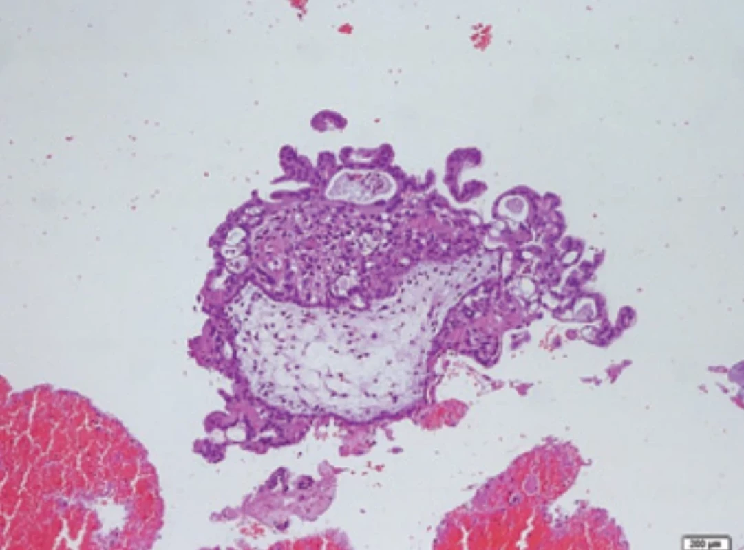 Circumferential trophoblastic hyperplasia (hematoxylin and eosin stain, 100×). Obr. 3. Cirkumferenční trofoblastická hyperplazie (barvení hematoxylinem a eosinem, 100×).