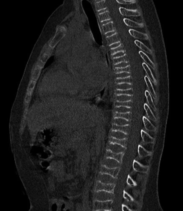 CT obraz bikonkávnej deformácie tiel stavcov.
Fig. 2. CT – biconcave vertebral body deformation.