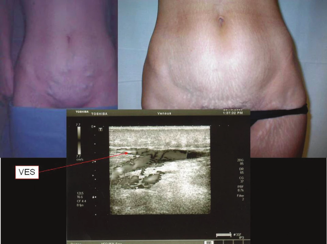 Recidiva varikozit z ponechané VES
Fig. 1. Relapses of varicosities of the retained VES