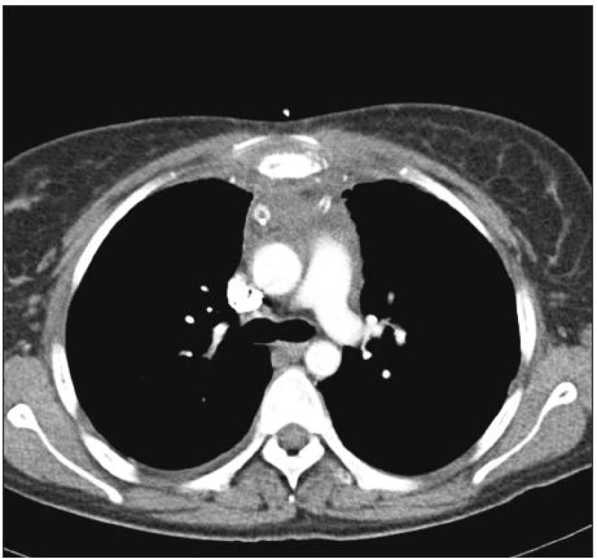 Sternumosteomyelitis mit Fraktur im kranialen Sternumdrittel und das Sternum umgebender Abszess (axialer Schnitt)