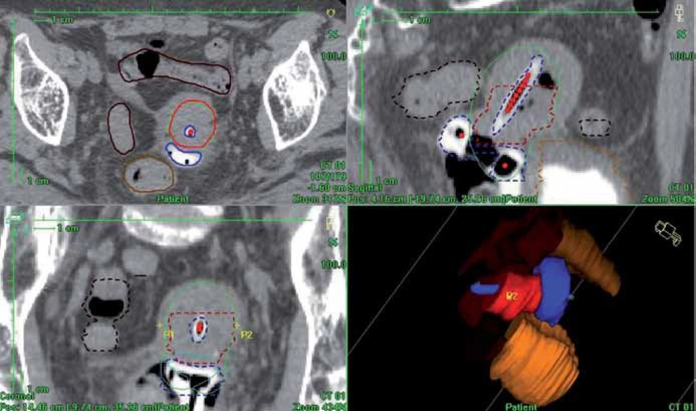 3D dávková distribuce vypočtená podle CT matice (plánovací systém Oncentra Masterplan). Červená barva – HR CTV; zelená – předepsaná dávka, 100% izodóza; modrá – aplikátor; světle hnědá – rektum; tmavě hnědá – sigmoideum; oranžová – močový měchýř.