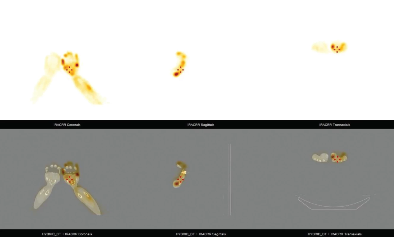 Snímky z hybridního vyšetření (SPECT na gama kameře GE OPTIMA 640 SPECT/CT s. n. 25196 s kolimátorem HR.) v různých rovinách (koronární, sagitální, transaxiální) a 3D rekonstrukce zachycují zvýšenou akumulaci 99mTc-HDP v pravé předloketní a zápěstní oblasti, (fenomén „hot glove“).