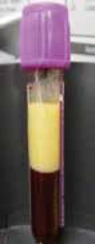 Sérum nemocného s HLP typ I