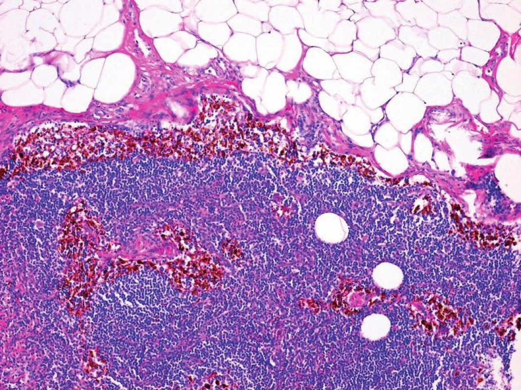 Histologický obraz pigmentofágů (siderofágů) v sinusech sentinelové uzliny (zvětšeno 100x)
Fig. 4: Histological view of the sentinel lymph node with macrophages containing iron deposits that are present predominantly in the sinuses (magnification 100x)