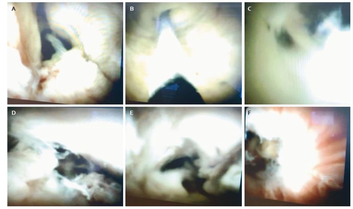 A. Lumen žlčovodu s polypoidnými výrastkami, B. oblasť junkcie, stenotické odstupy hepatikov, zavádzač, C. oblasť junkcie, D a E. proximálny choledochus a junkcia, výrazná hlienotvorba, F. stenóza distálneho choledochu.
Fig. 3. A. Choledochus lumen with irregular polypoid structure surface, B. junction, stenosis of both hepatic ducts, guidewire, C. biliary junction, D and E. proximal choledochus and junction, mucus overproduction, F. distal stenosis of the choledochus.