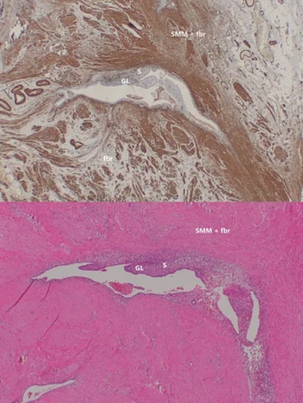 Histopatologický nález preparátu z endometriálního nodulu rekta s výraznou fi brózou a hypertrofi ckou hladkou svalovinou (SMM+fbr – hladce svalová metaplázie s fi brózou), endometriální žláza (GL). Je evidentní jen minimální objem stromatu (S). Preparát z resekátu uzlu z obr. 7. Dolní část barvení H+E (hemotoxylin + eosin), horní část imunohistochemické barvení na aktin.