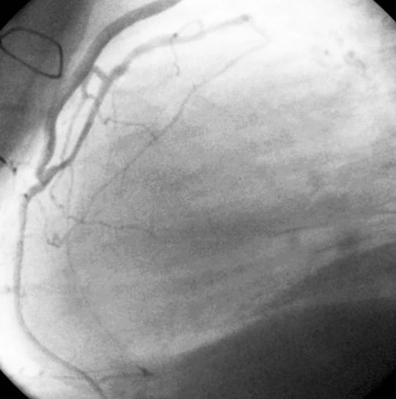 Intimní vztah manubria hrudní kosti a tepenného štěpu LIMA – RIA.
Fig. 3. Close relationship between the sternal manubrium and the LIMA – RIA arterial graft