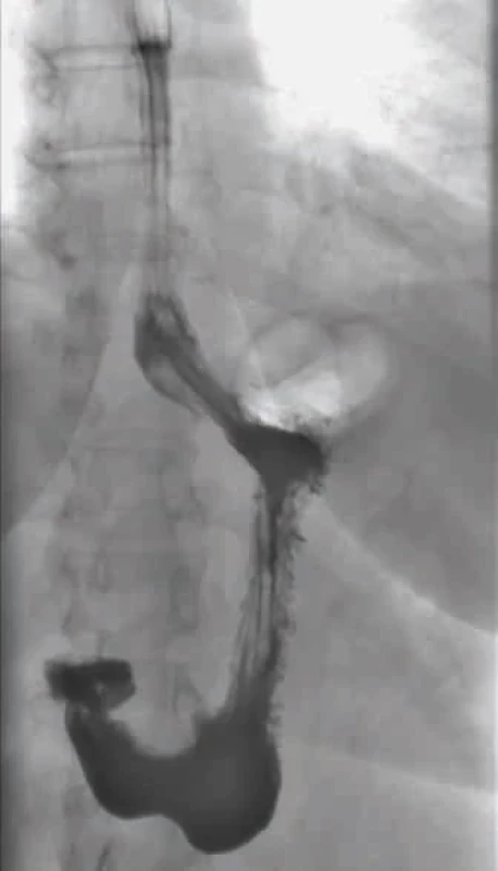 Skiaskopické vyšetření jícnu a žaludku. An upper gastrointestinal study of the oesophagus and stomach.