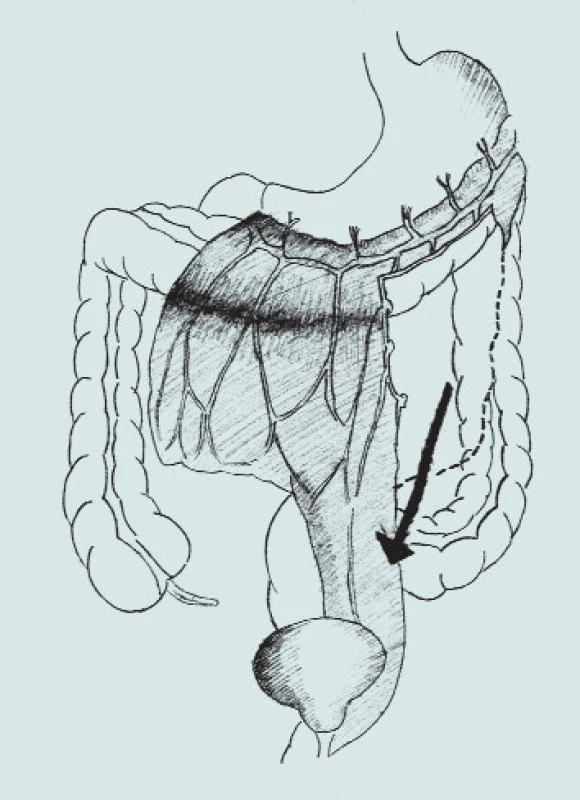 Autoaugmentace s omentoplastikou.