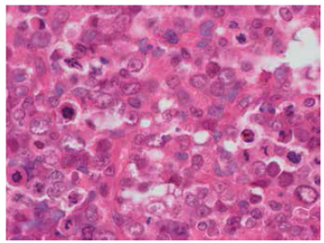 Nízce diferencovaný/kulatobuněčný sarkom, hematoxilineosin, 400x. Solidně utvářený, nízce diferencovaný nádor složený z epiteloidních, silně anizomorfních buněk s objemnými jádry a nápadnými nukleoly. Buněčné hranice jsou nezřetelné, místy mají nádorové elementy až syncytiální charakter a disperzně jsou přítomny mnohojaderné obrovské buňky. Mitotická aktivita je velmi vysoká, s přítomností atypických mitóz.