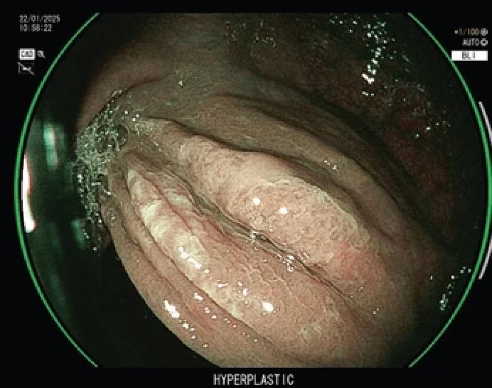 CADx, Fujinon, označení hyperplastického polypu.