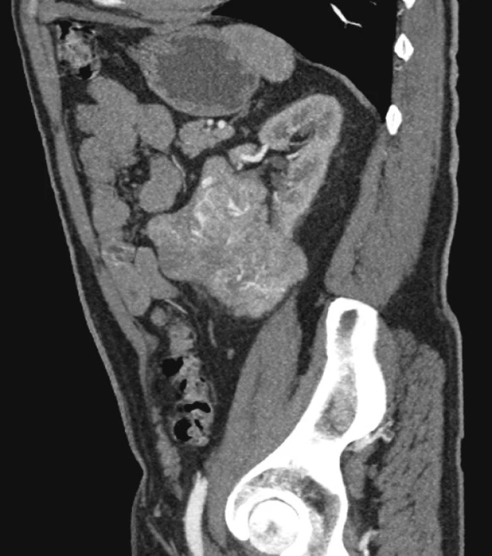 CTA obraz tumoru levé ledviny
Fig. 1. CTA view of the left kidney tumor
