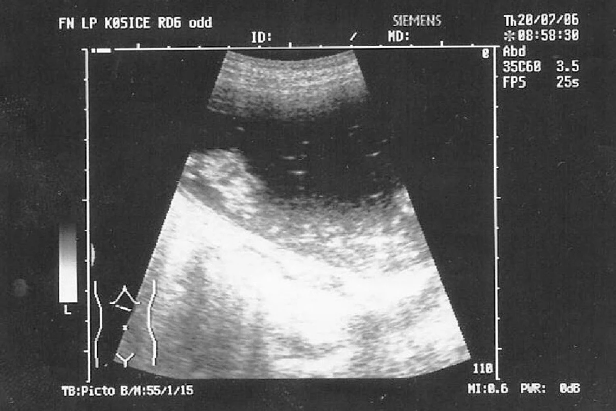 Ultrasonografia abdomenu – dilatácia žalúdka nad prekážkou
Pic. 4. Ultrasonography of abdomen – stomach dilatation above the obstruction