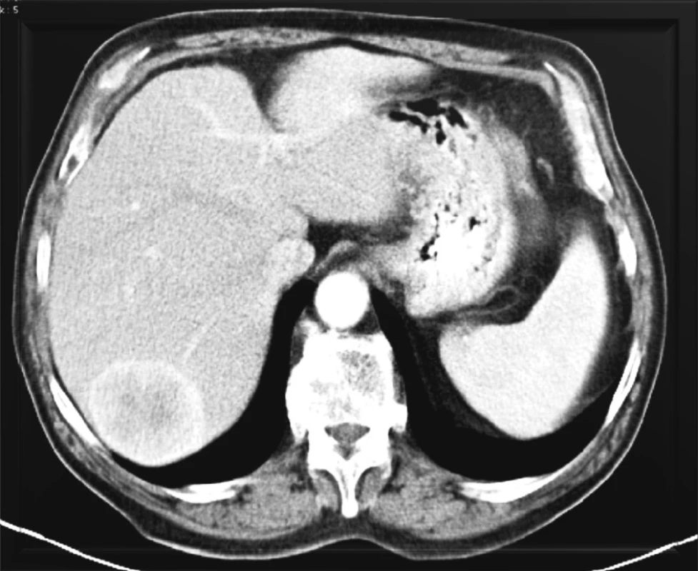 Hypervaskularizovaná metastáza karcinoidu v pravém laloku jater
Fig. 1. Hypervascularized carcinoid metastasis in the right liver lobe