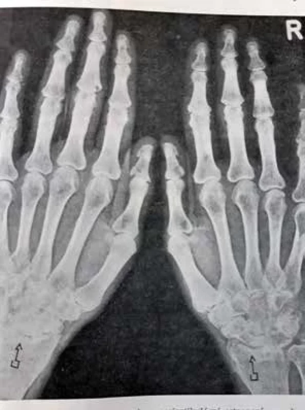 Revmatická polyartritida s projevy periartikulární osteoporózy, s obvodovými usuracemi v proximální řadě interfalangeálních kloubů