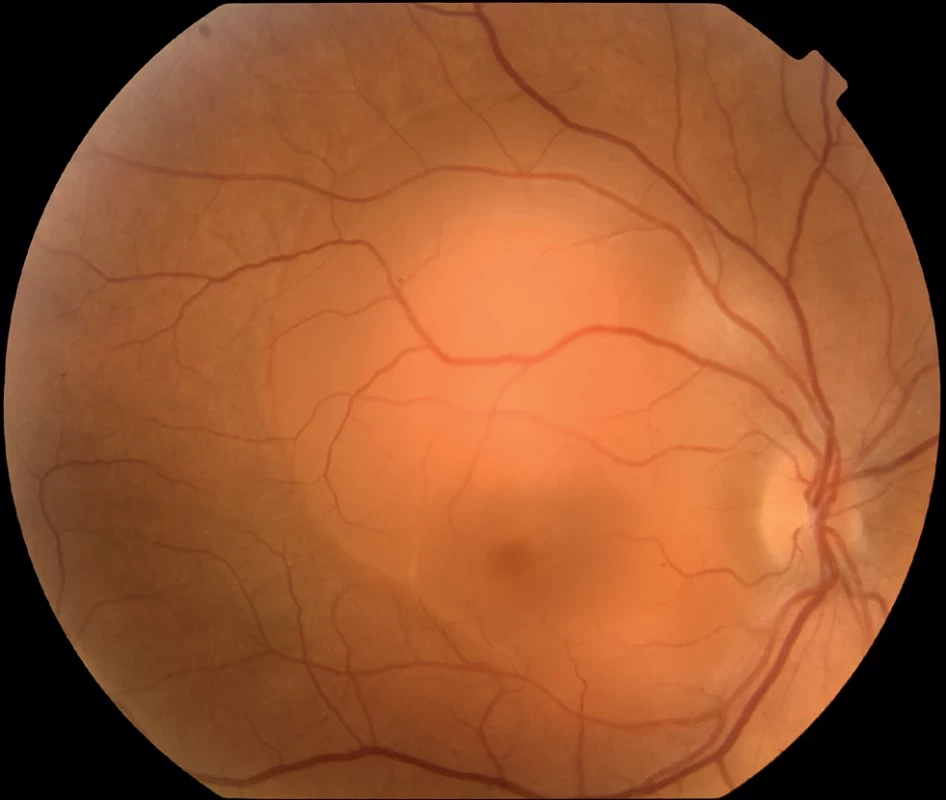 Fundus photograph of the right eye at the time of diagnosis of exudative retinal detachment. A high exudative retinal detachment is localized in the macular area without extending beyond the temporal arcades