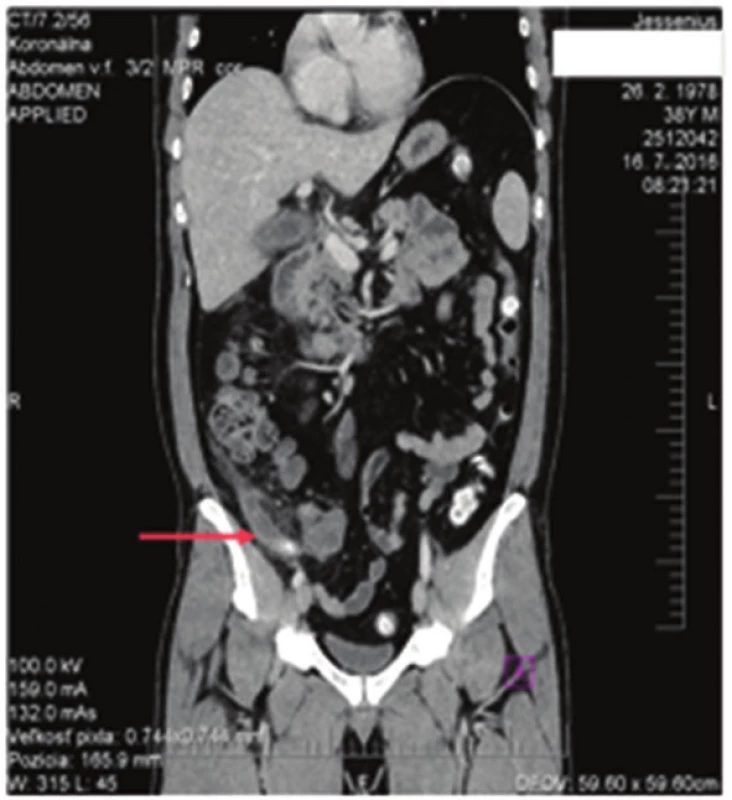 Akútna apendicitída
Fig. 1: Acute appendicitis