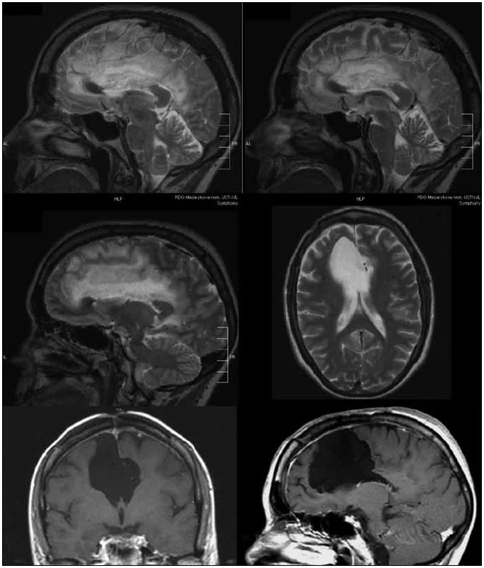 46letá pacientka po parciální resekci oligodendrogliomu grade II v oblasti gyrus frontalis superior, gyrus cinguli a corpus callosum vpravo v roce 2006, v roce 2009 subtotální operace recidivy gr. II–III v oblasti gyrus cinguli,
následovala onkologická léčba, v mezidobí pracovala i přes extenzivní resekci corpus callosum jako účetní.