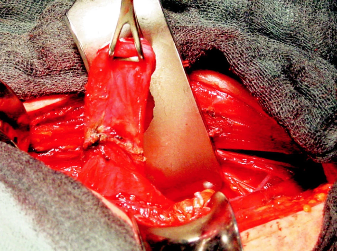 Vypreparovaný Zenkerův divertikl
Fig. 2. The Zenker’s diverticle preparation