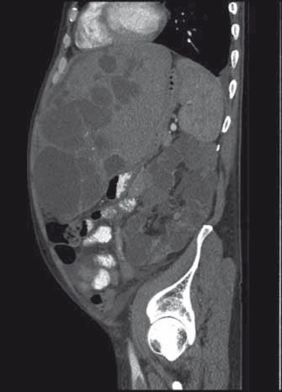 Expanze jater a ledvin při polycystóze.
Fig. 3. Polycystic liver and kidney expansion.