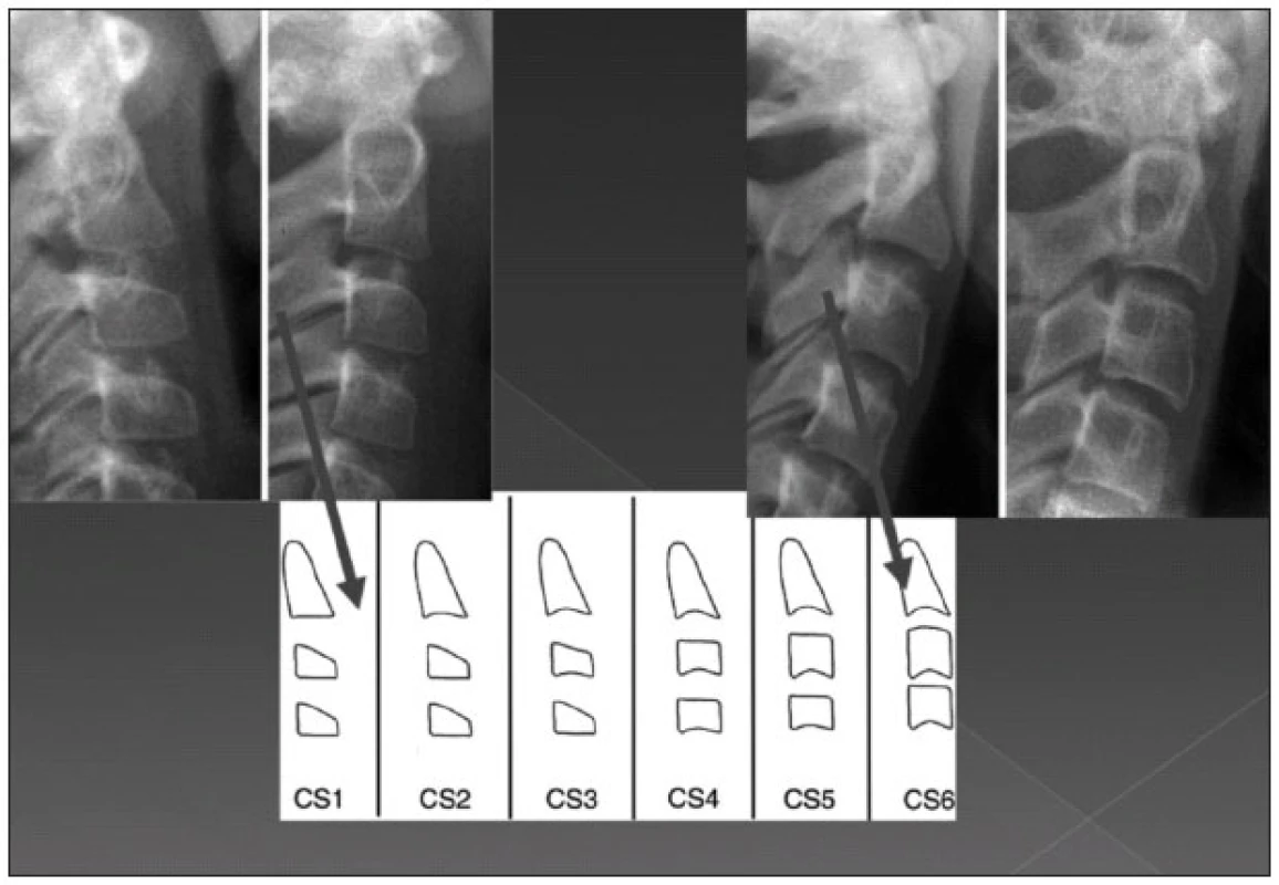 Určení ukončení růstu kraniofaciálního skeletu pomocí telerentgenogramu.Upraveno podle: Baccetti T., Franchi L., McNamara J. A.: The Cervical vertebral maturation method for the assessment of optimal treatment timing in dentofacial orthopedics. Semin Orthod Elsevier Inc., 11, 2005, s. 119-129 [1].