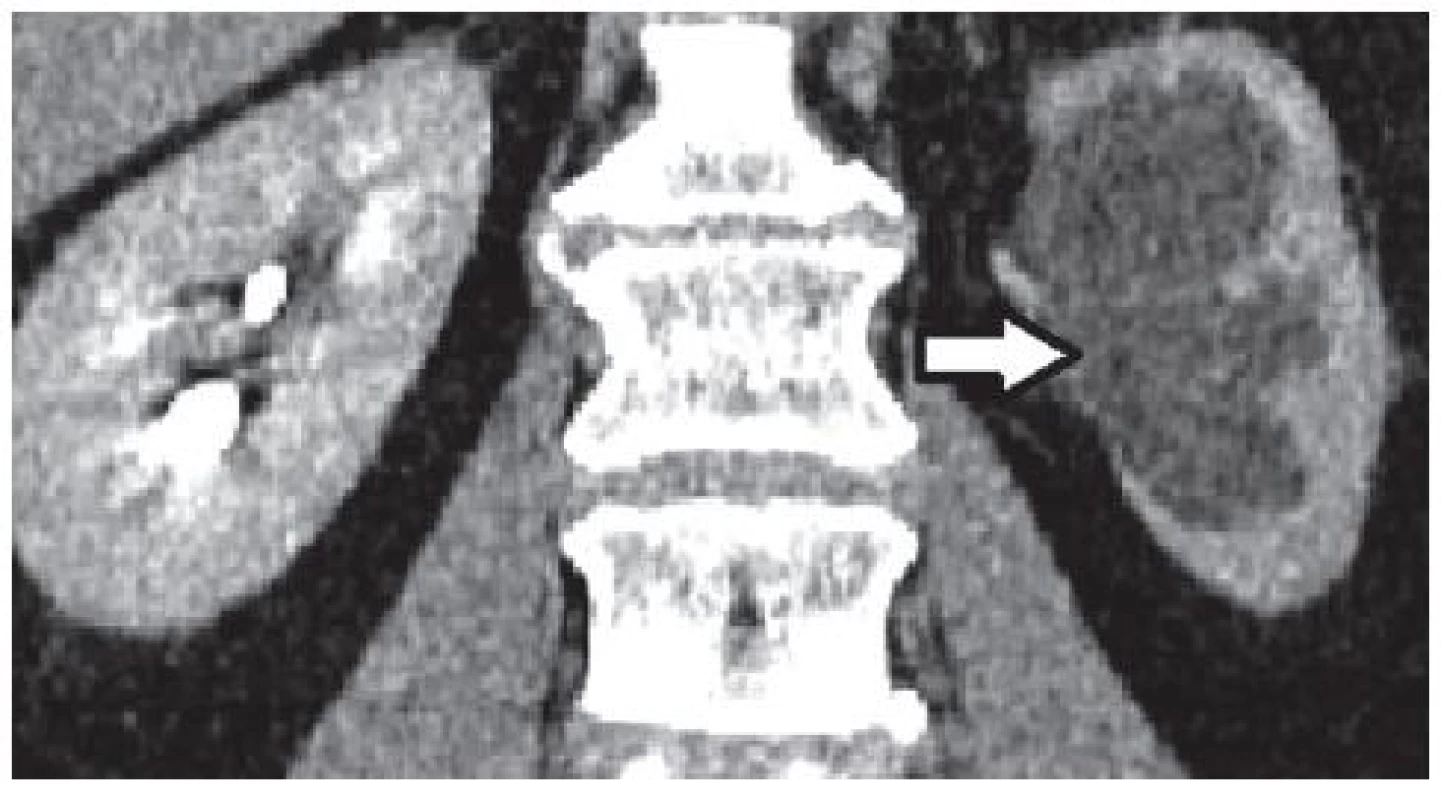 CT po podání intravenózní kontrastní látky – šipka ukazuje na afunkční ledvinu vlevo s hydronefrózou
Fig. 4. CT after administration of intravenous contrast material – the arrow points to the left non-functioning kidney with hydronephrosis