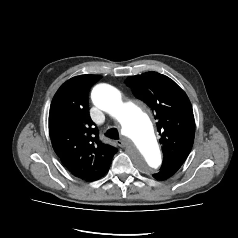Aneurysma oblouku aorty – kontrastní CT vyšetření hrudníku, axiální projekce