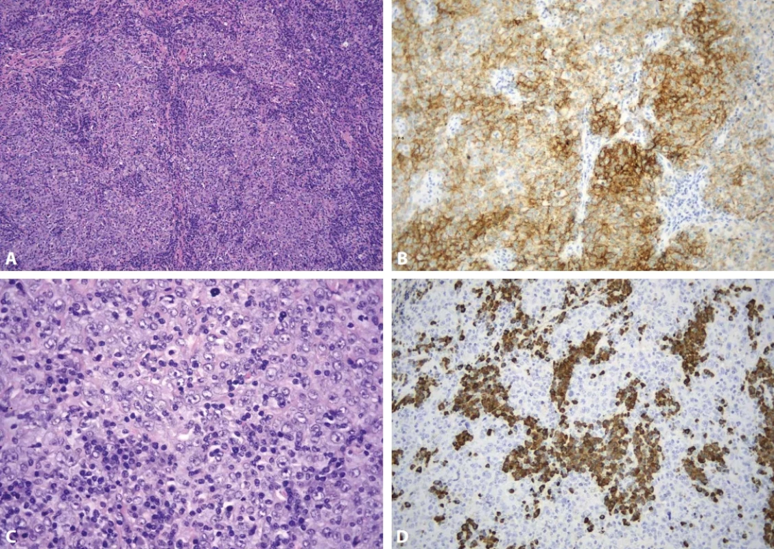  Sarkom z folikulárních dendritických buněk. Lymfatická uzlina je prostoupena pruhovitou a nodulární proliferací (A, hematoxylin-eosin, 100x) s expresí antigenu CD21 (B, 200x). Nádorové buňky jsou ovoidní až protáhlé, s prominentními jadérky a v jejich okolí je nápadná příměs lymfocytů a plazmocytů (C, hematoxylin-eosin, 200x). Plazmocytóza je v tomto případě velmi nápadná, zvýrazněná v průkazu lehkých řetězců kappa (D, 200x). Plazmocytóza v tomto případě byla polytypická (nezobrazeno). 