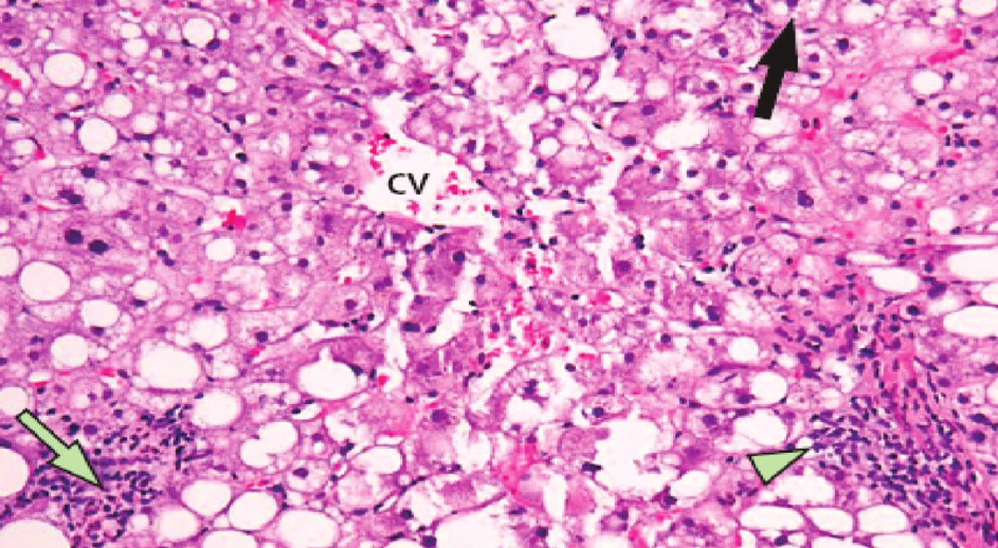 Projev hepatotoxicity neoadjuvantní chemoterapie – steatohepatitida
