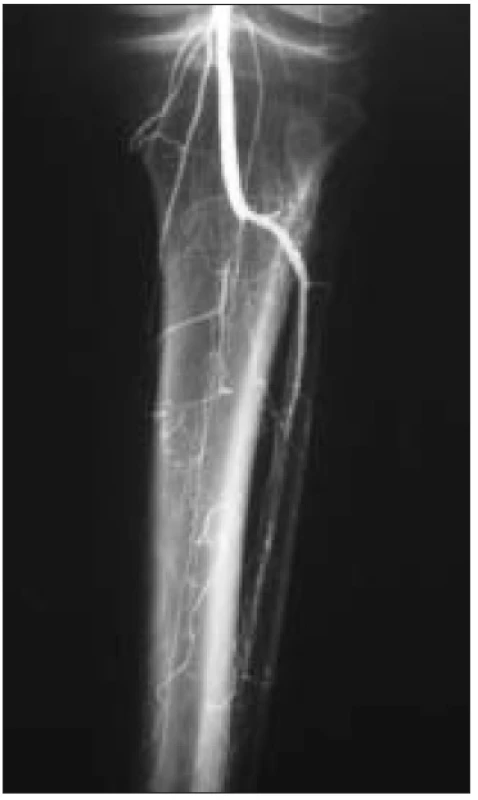 Angiografie – fragmentace bércového řečiště, jediná bércová tepna.