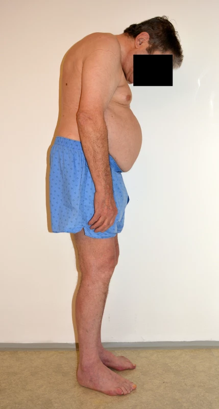 Ankylozující spondylitida <em>(z fotoarchivu Revmatologického ústavu)</em>