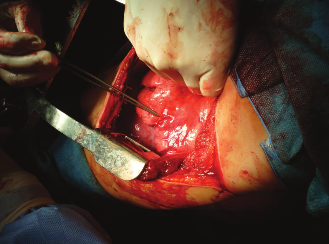 Perioperační nález sutura dolního laloku levé plíce
Fig. 7. Perioperative finding – left lower inferior lobe suture