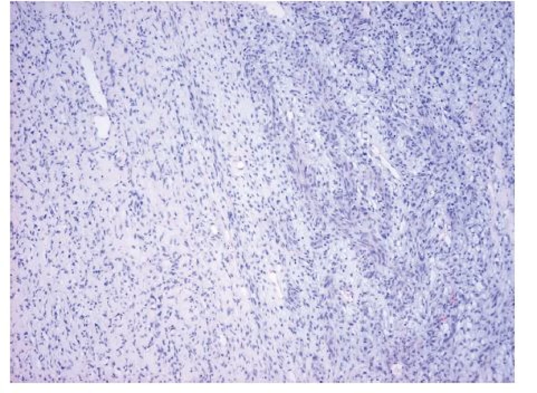 Mamografie – pravý prs vyplněn maligním fyloidním tumorem 17x17x11cm
Fig. 4: Mammography – right breast filled with malignant phyllodes tumour sized 17x17x11 cm
