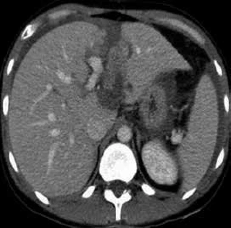 Postkontrastní CT vyšetření v portovenózní fázi s patrnou hypodenzní oblastí v levém laloku lemující falciformní ligamentum charakteru hematomu.